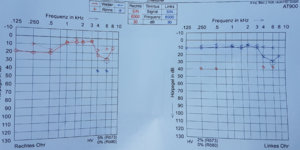 ask forum tinitus; aud 1500 si 2000 hz ( si alte componente).jpg