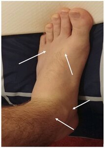 Tinnitus Acupuncture Foot-Ankle Locations.JPG