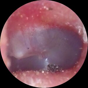 glue-ear-ear-drum-mine.jpg