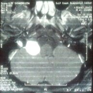 Brain Tumor Dave